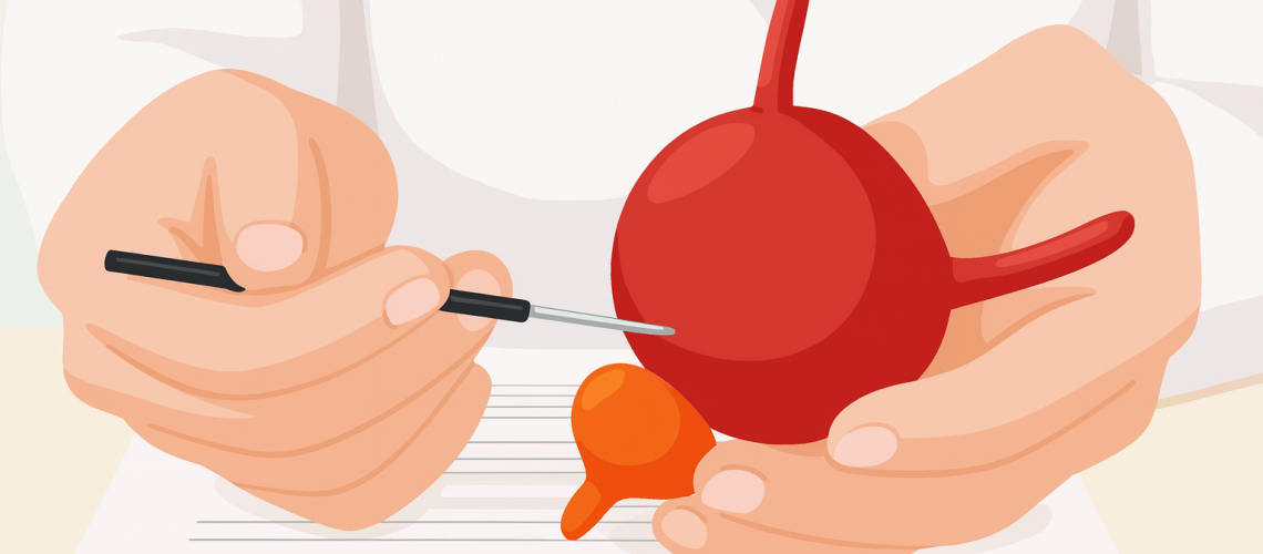 Exposição Ocupacional e Câncer de Bexiga_ Profissões de Risco e Medidas Preventivas